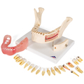 Zahnerkrankung, 2-fache Größe, 21-teilig – 3B Smart Anatomy