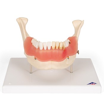 Zahnerkrankung, 2-fache Größe, 21-teilig – 3B Smart Anatomy